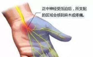鼠标手康复与腕管综合征自测保守治疗全解析
